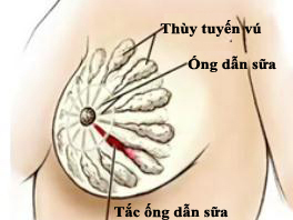 BÀI THUỐC ĐẶC TRỊ TẮC TIA SỮA - PHƯƠNG CÁCH GIA TRUỀN CỔ XƯA BÀI THUỐC ĐẶC TRỊ TẮC TIA SỮA - PHƯƠNG CÁCH GIA TRUỀN CỔ XƯA